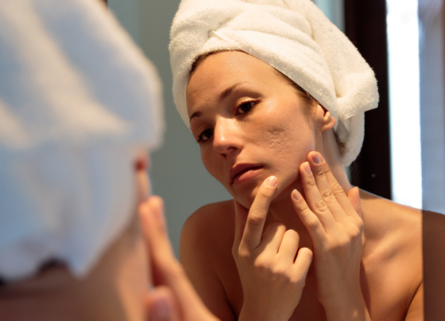 mulher examinando rosto para procurar acne